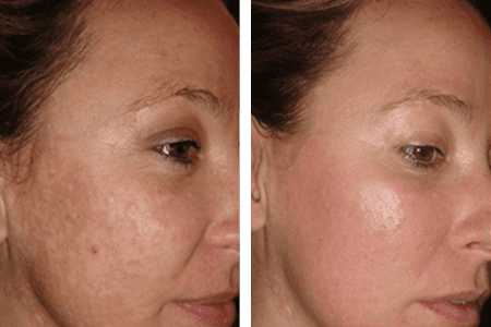 Laser Acne Scar - Abu Dhabi